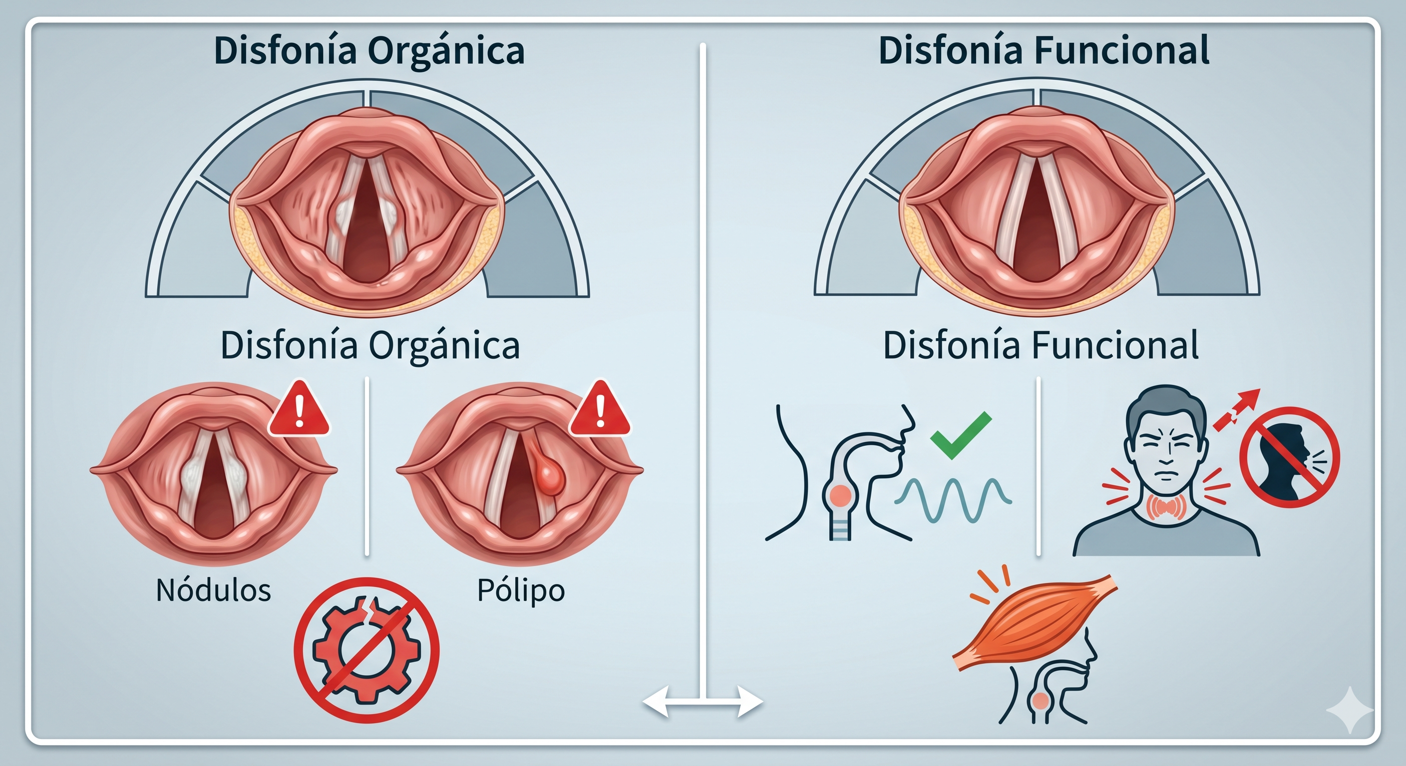 Disfonía Orgánica y Funcional